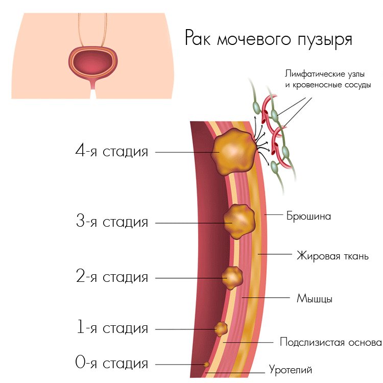 Химиотерапия рака мочевого пузыря: виды, побочные реакции, эффективность, подготовка